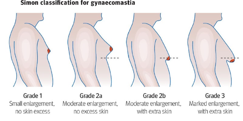 Simon Classification for Gynaecomastia
